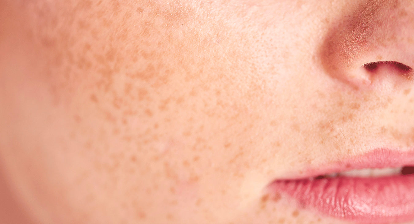hyperpigmentation-image.jpg