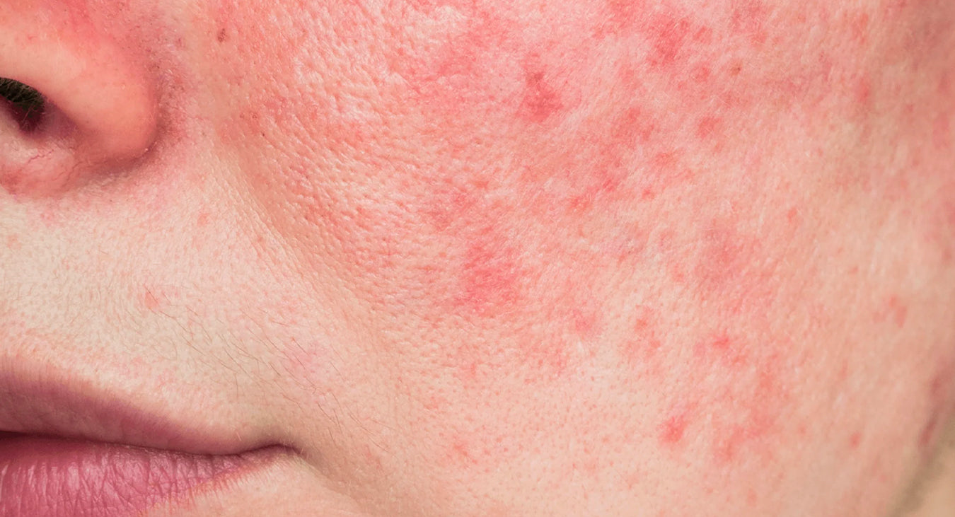 redness-image.jpg