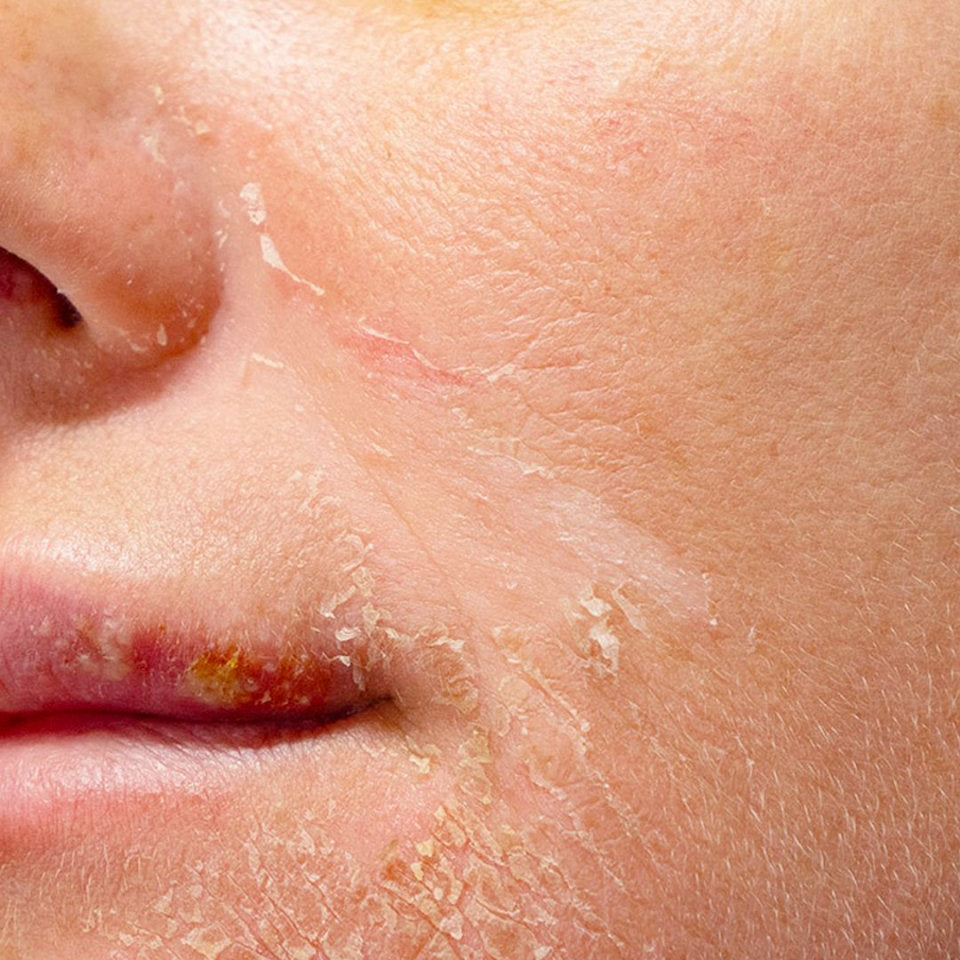 Peau sèche - Day to Joah